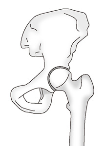 加畑 多文 先生 股関節に痛みをもたらす疾患とその治療法 第324回 変形性股関節症の原因にあった適切な治療を受けましょう 人工関節ドットコム