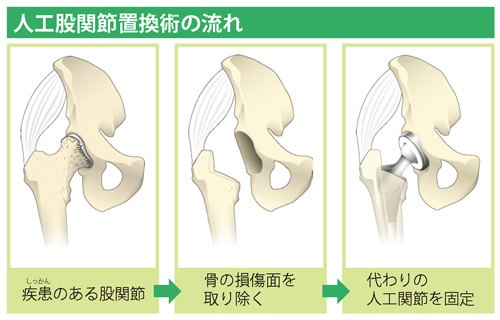 人工股関節置換術の流れ