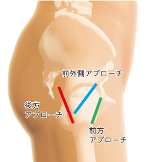 前方アプローチと前外側アプローチと後方アプローチ