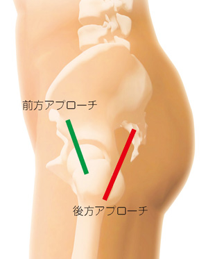 前方アプローチと後方アプローチ