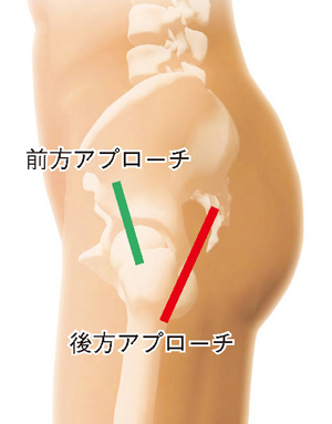 前方アプローチと後方アプローチ