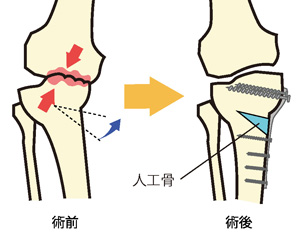 骨切り術