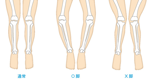 通常とO脚とX脚