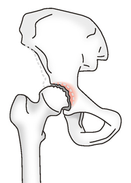 変形性股関節症