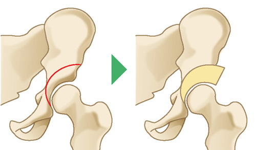 寛骨臼回転骨切り術