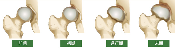 変形性股関節症の進行