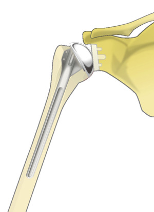 人工肩関節置換術