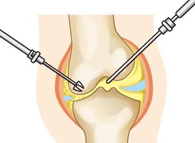 関節鏡視下手術