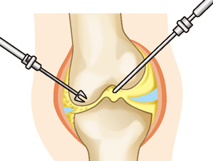 関節鏡手術