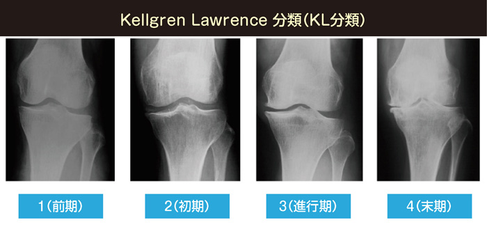 Kellgren Lawrence分類（KL分類）