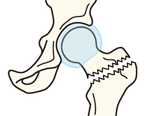 転子部骨折