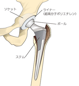 人工股関節の一例