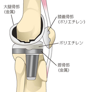 人工膝関節の一例