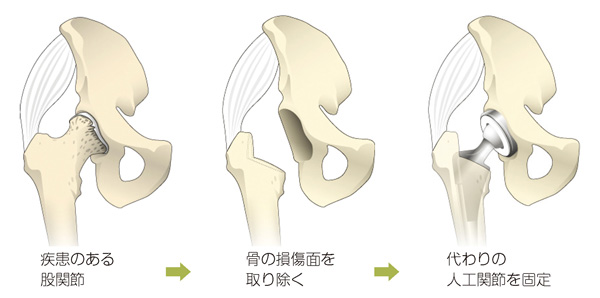 人工股関節置換術の流れ