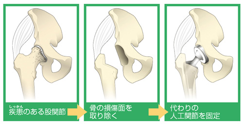 手術フロー図