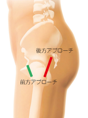 前方アプローチと後方アプローチ