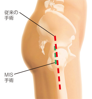 従来の手術とMIS手術