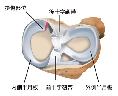 内側半月板の後根断裂