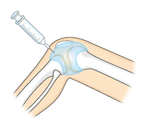 ヒアルロン酸の関節注射