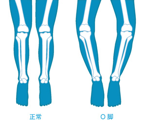 正常な膝とO脚