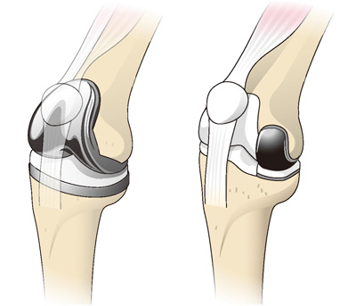 全置換術（左）と単顆置換術（右）の一例