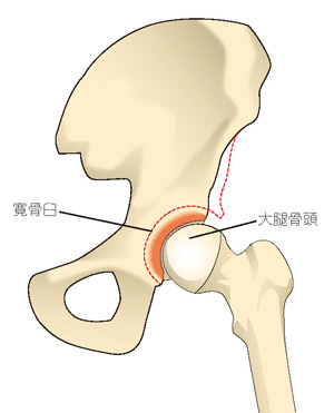 寛骨臼形成不全