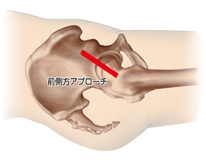 前側方アプローチ