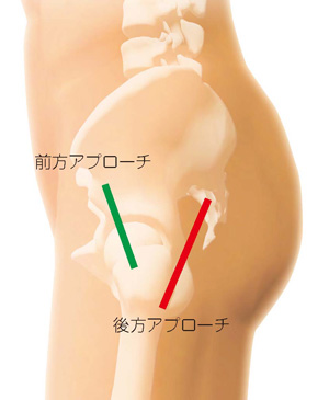 前方アプローチと後方アプローチ