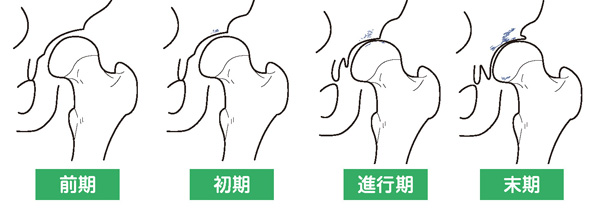 変形性股関節症の進行