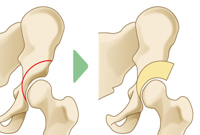 関節温存手術（骨切り術）
