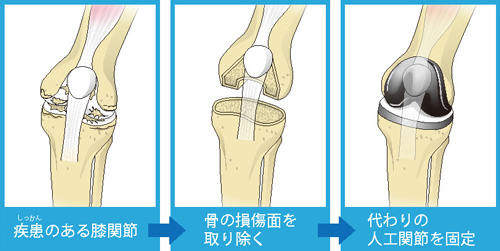 全置換術の流れ