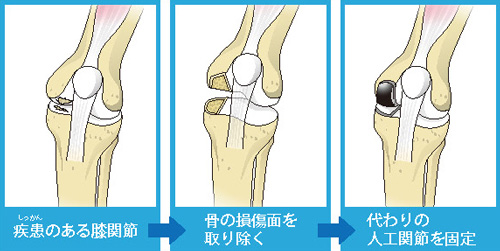 単顆置換術の流れ