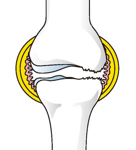 軟骨がすり減り炎症した膝