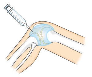 関節内注射