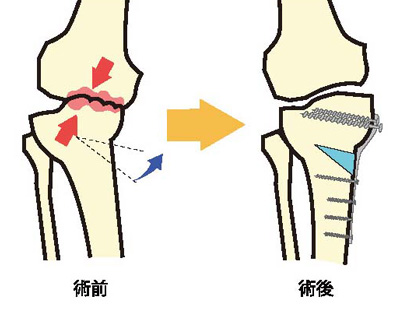 骨切り術の一例