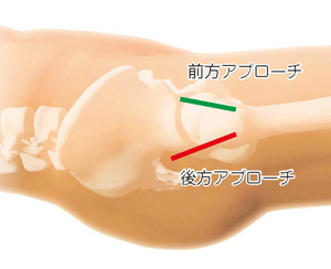 前方アプローチと後方アプローチ