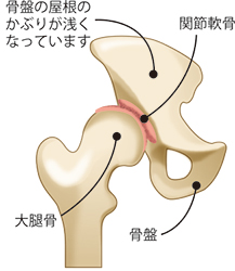 山口 仁 先生 適切な治療タイミングを逃さないためには早めの受診が肝心 第38回 我慢は禁物 重症化する前に専門医に相談し 適切なアドバイスを受けよう 健康長寿で豊かな生活を目指す 人工関節ドットコム