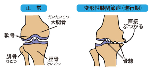 正常な膝と変形性膝関節症（進行期）