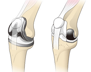 人工膝関節全置換術（左）と部分置換術（右）