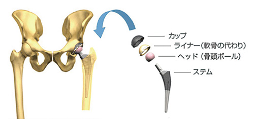 人工股関節は4つの部品で構成されている