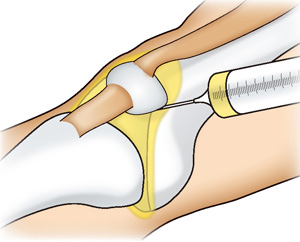 膝の関節液を抜き、ステロイドと局所麻酔薬を注射すると劇的に痛みが改善
