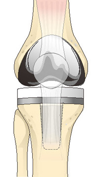 人工膝関節置換術