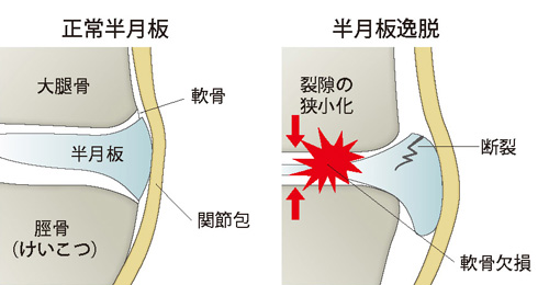 正常半月板と半月板逸脱