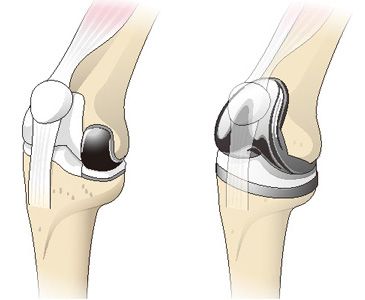 人工膝関節単顆置換術（左）と人工膝関節全置換術（右）