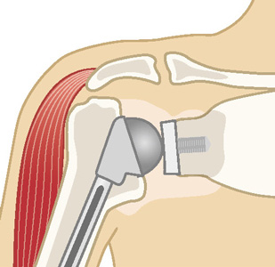 従来の人工肩関節