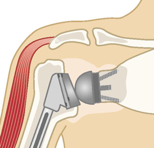 リバース型人工肩関節