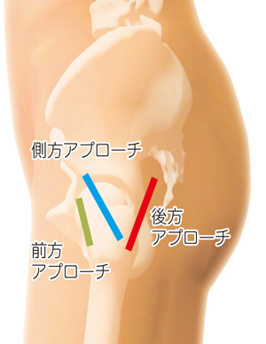 前方アプローチと側方アプローチと後方アプローチ