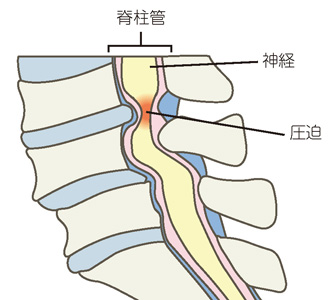 腰部脊柱管狭窄症