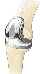 人工膝関節置換術