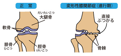 正常な膝と変形性膝関節症（進行期）